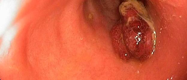 Endoscopic Removal of Polyps