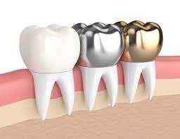 Dental Crowns: What are the Different Types?