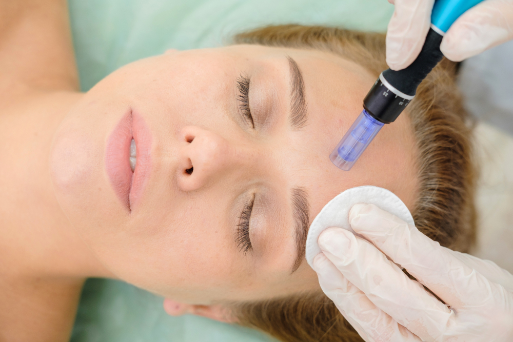 Answering all your viral questions about microneedling!