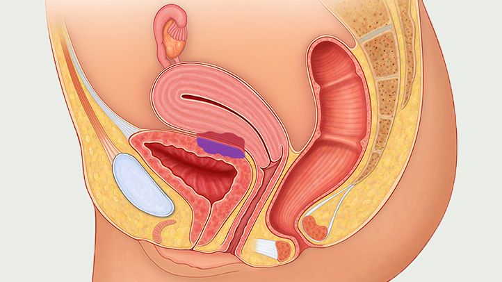 What Is Endometriosis, Its Causes, And Symptoms