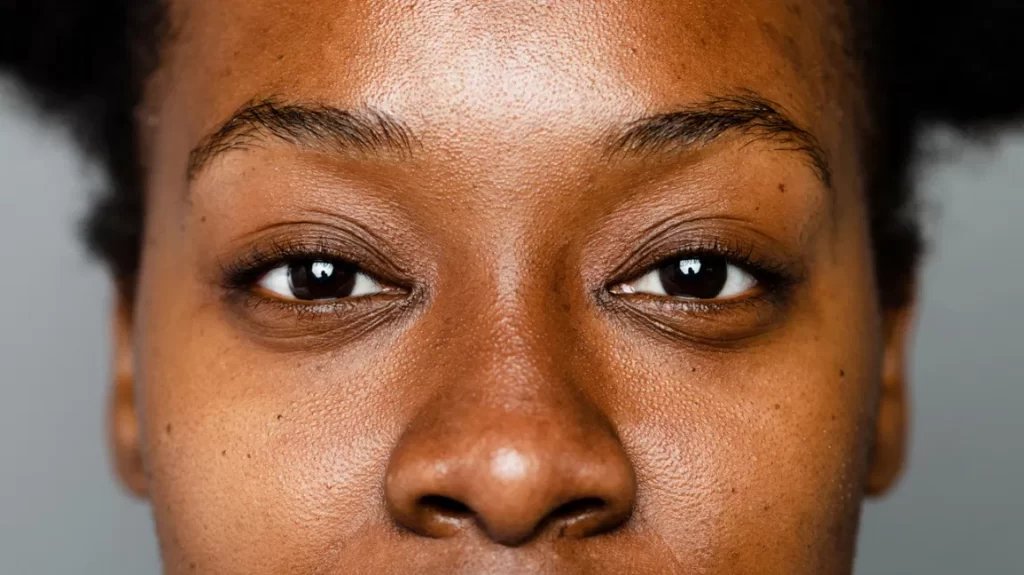 Understanding Hyperpigmentation and Pigmentation Removal Options