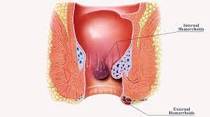 What are the Symptoms and Causes of Piles?