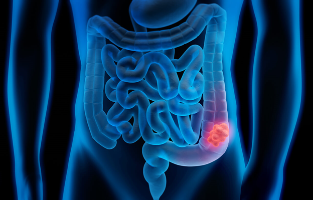 6 tips to Manage Your Colon Cancer Symptoms After Diagnosis