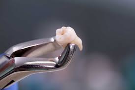 The Ultimate Guide to Wisdom Tooth Extraction