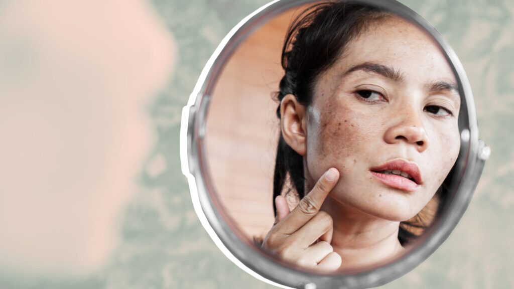 Melasma Treatment: The Best Non-Surgical Solution for This Common Skin Concern