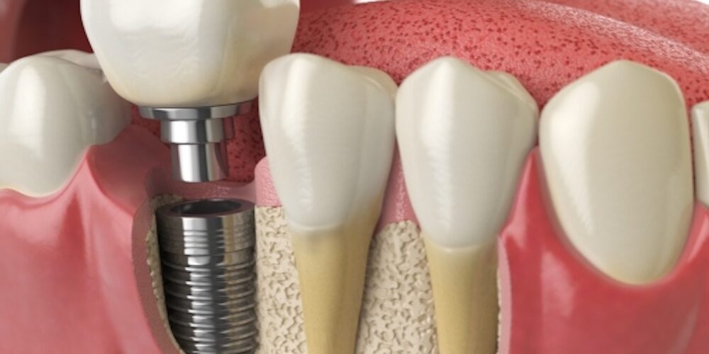 Smile With Confidence: Understanding The Benefits And Procedure Of Dental Implants