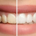 Ultimate Guide to Philips Zoom Whitening