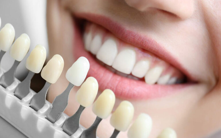 How to Determine the Best Smile Makeover for Stained Teeth?