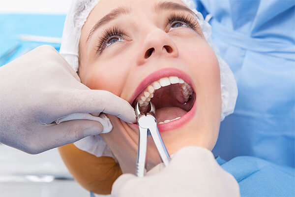3 Amazing  Benefits of a Dental Extraction in Brooklyn 