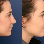 Rhinoplasty Surgeon Near Me