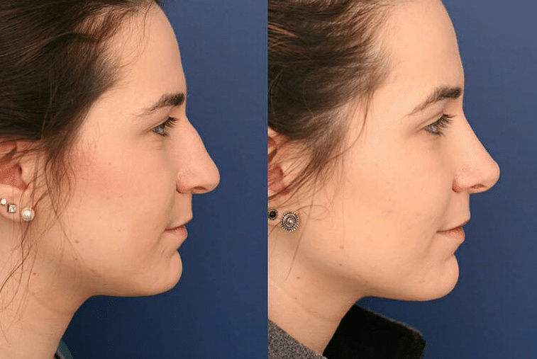 Finding the Right Rhinoplasty Surgeon Near Me