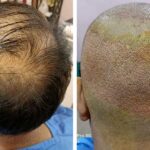 Turkey Hair Transplant Post-Op Care - What To Expect