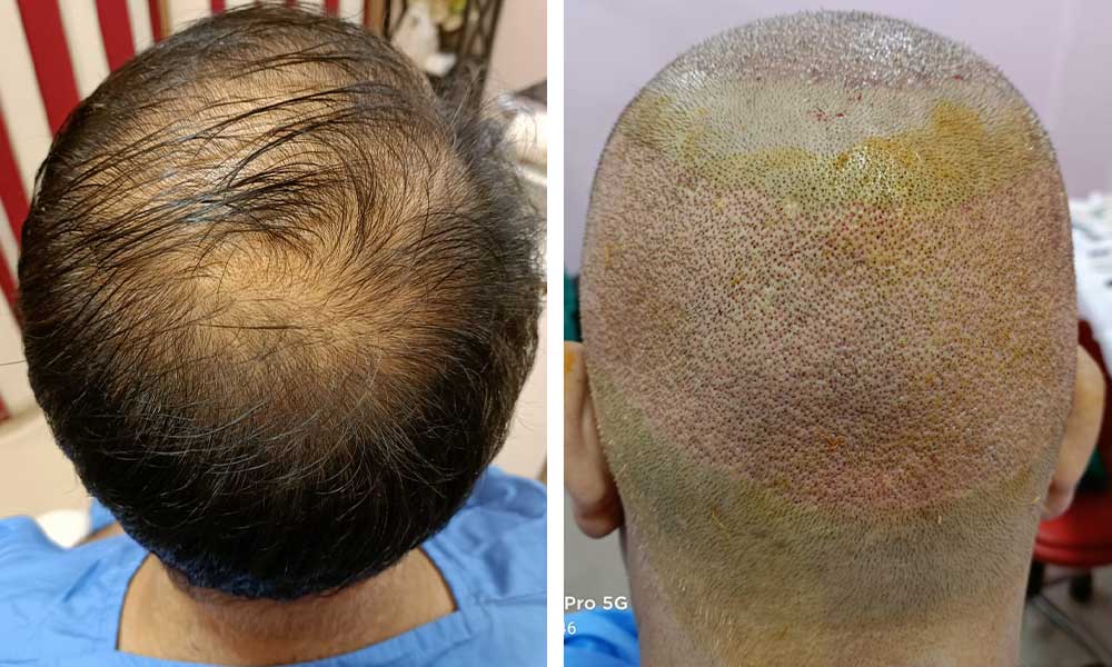 Turkey Hair Transplant Post-Op Care – What To Expect?