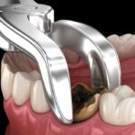 Right Wisdom Tooth Removal Services