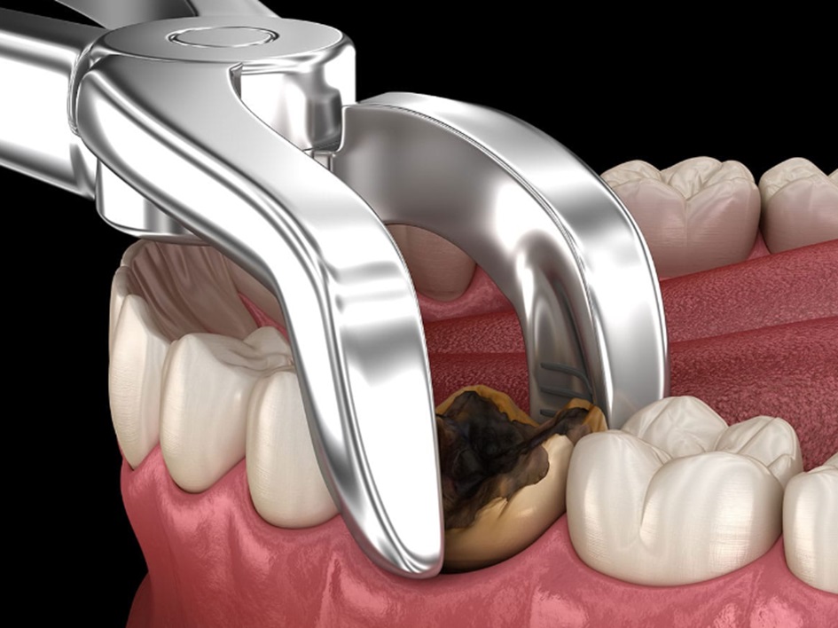8 Tips on Choosing the Right Wisdom Tooth Removal Services