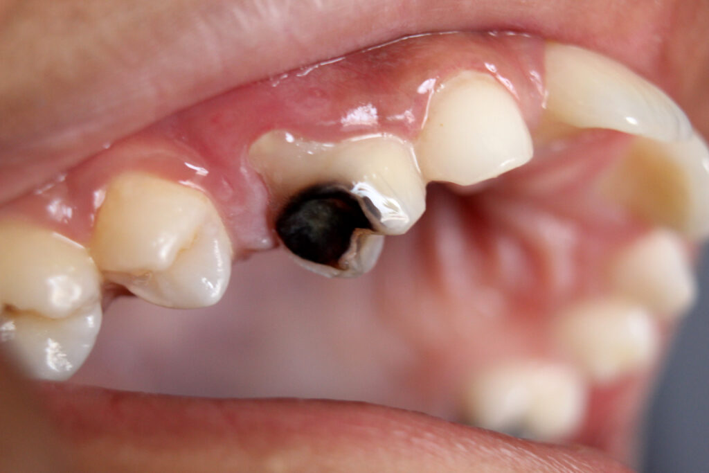 How Do You Get Dental Cavities in Redlands?