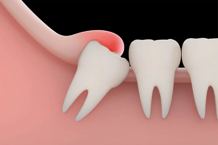 Signs That You Need A Wisdom Teeth Removal