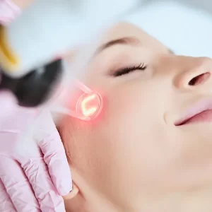 Fractional CO2 Laser treatment