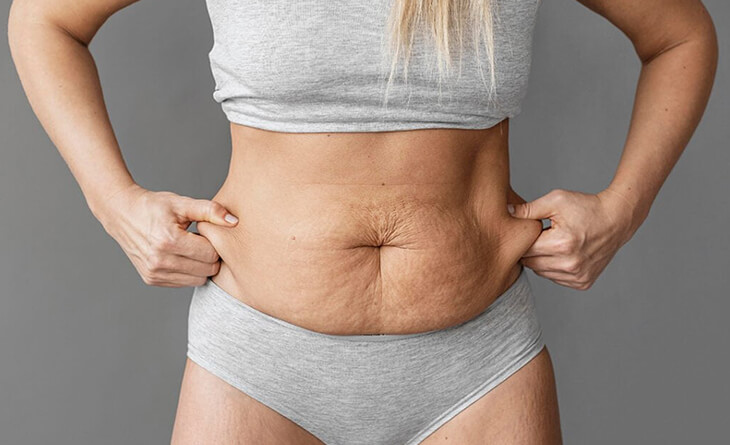  Tummy Tuck