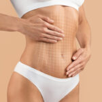 Tummy Tuck